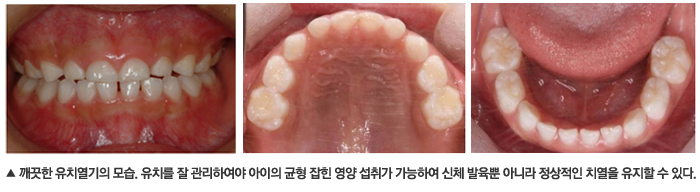 어린이 충치 영구치까지 발전하지 않도록